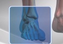 Here&how surgeons treat a high ankle sprain injury
