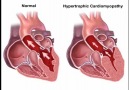 Hipertrofik Kardiyomyopati - Medikal Paylaşım