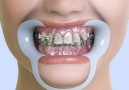 How Braces Work