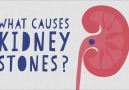 How do kidney stones form in the body And why are they so painful to get out