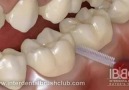 How to brush under implants and braces Dental 3D animation