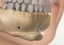 How to get the perfect smile via AvA Orthodontics & Invisalign