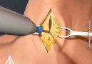 Hugot ko - Tracheostomy surgery Facebook