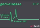 Hyperkalaemia ECG changes animated