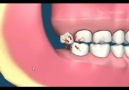 Impacted Wisdom Teeth Removal (Animation)