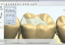 Inlay_ Onlay&Veneers 3 D