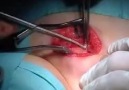 İnmemiş Testis Ameliyatı (Orşidopeksi)