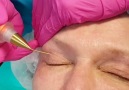 JETT Plasma Devices - Blepharoplasty DK Irena Pluhar