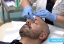 JETT Plasma Devices - Fibroma removal on the nose