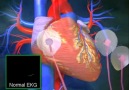 KALPTE LETİ SİSTEMİ VE EKG - Medikal Paylaşım