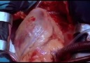 Kalp ve Açık Kalp Ameliyatı...