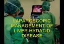 Karaciğer Kist Hidatik Ameliyatı (Laparoskopik)