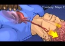 Kardiyopulmoner Resütasyon (CPR)