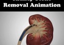 Kidney Stone Removal Animation