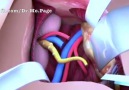 Kidney Transplant