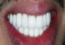 Kiss Prank - İSTER İNANIN İSTER İNANMAYIN - 10 Dakikada Bembeyaz Dişlere Sahip Olun ( Süper Yöntem )