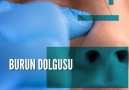 Koral Klinik - Burun dolgusu burundaki kemer ya da...