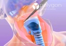 Laryngectomy Surgical Voice Restoration