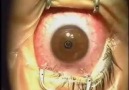 Lasik Eye Surgery - Old