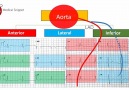 Localisation of culprit Coronary artery with ECG...