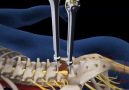 Lumbar Fusion of L5 S1 Animation