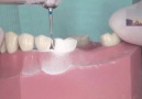 Mandibular Molar Preparasyonu