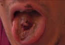 Man's Vaping Device Explodes - Blows Fleshy Hole in His Tongue