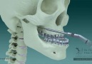 Maxillary Advancement Surgery