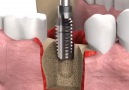 Max Jr - Dental Implant Procedure.... Facebook