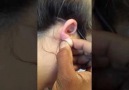 Maya - Popping Cyst on Girl Friend&Ear Facebook