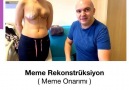 Meme rekonstrüksiyon (Meme Onarımı)... - Op. Dr. Diren Çelik