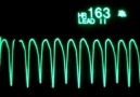 Ölümcül Aritmiler - EKG ve Güncel Protokoller