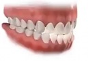Orthodontic ElasticsAvA Orthodontics & Invisalign