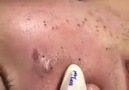 Popper - An awesome blackhead extraction