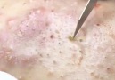 Popper - Blackheads extractions very relaxing to watch...