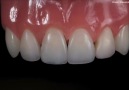 Practical course Direct restoration of frontal teeth