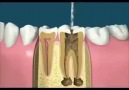 Process of Root Canal!