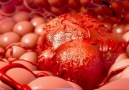 Researchers induce the immune system to prevent recurrent bladder cancer.