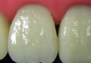 Restoration of anterior fractured tooth