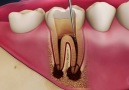 Root Canal Procedure