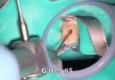 Root Canal Procedure from start to end.