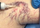 Say goodbye to varicose veins Via Vein Treatment Center