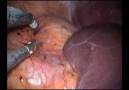 Single Incision Laparoscopic Nephrectomy