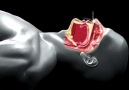 Sleep Apnea 3D animation