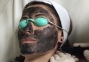 Tattooclinic Dövme silme - Karbon peeling işlemi Facebook