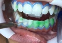 Teeth Whitening