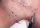 The Daily Medical - Long and Satisfying Blackhead Extractions Facebook