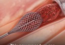 This amazing new procedure can remove blood clots entirely