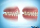 This Is How Dental Braces Work!!