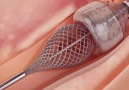 This little device help doctors remove large blood clots more easily